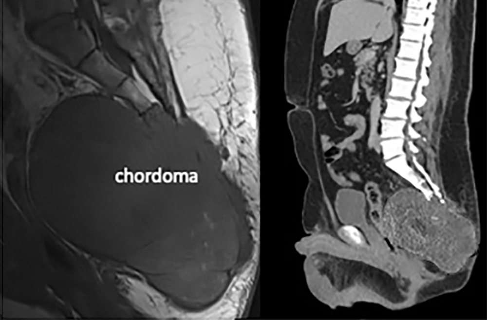 Precision En Bloc Resection For Sacral Chordoma - Penn Medicine